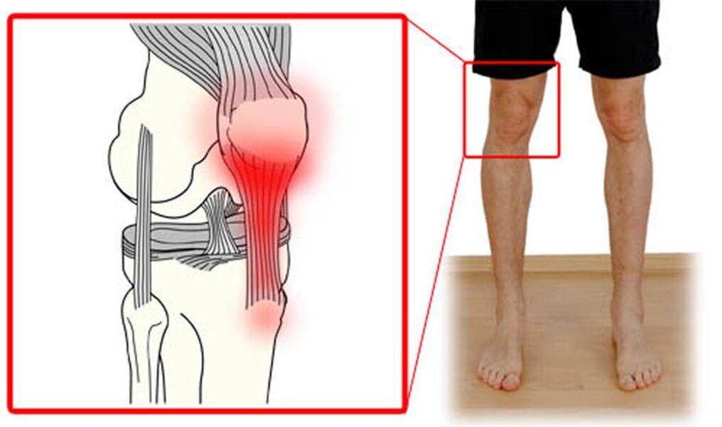 Tendinitis - upala tetiva u zglobu koljena