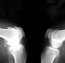 Osteoartritis na rendgenskoj