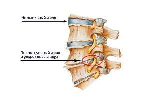 Simptomi vratnog osteoartritis