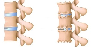 kako prepoznati prisutnost osteohondroze lumbalne kralježnice