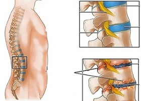 uzroci osteohondroze lumbalne kralježnice