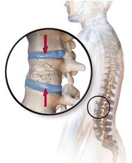 Osteoporoza izaziva bolove u leđima u lumbalnoj regiji