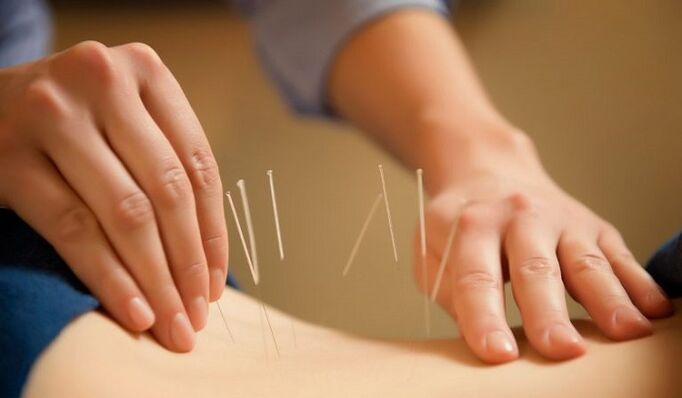 akupunktura za liječenje bolova u križima